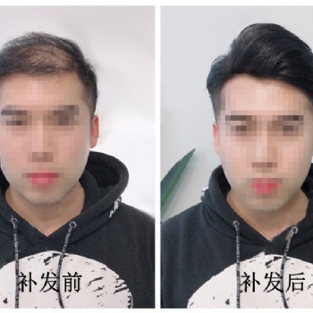 南阳假发定制千丝美补发还您一头自然靓丽的秀发