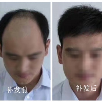 南阳中老年脱发少发人群定制假发，选专业机构就对了